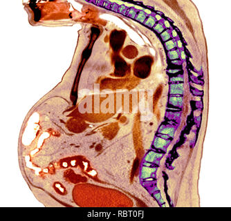 Wirbelsäule in ankylosing spondylitis. Farbige X-ray von einem Abschnitt durch die brustwirbelsäule eines 74-jährigen männlichen Patienten mit Morbus Bechterew, Sho Stockfoto