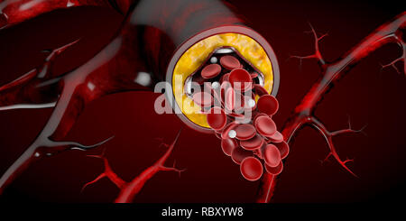 Stent medizinisches Konzept Implantat als eine Herzkrankheit Behandlung Symbol 3D-Abbildung. Stockfoto