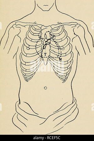 . Richtungen für die Arbeit im Labor in der Physiologie. Physiologie. Normale Sounds von ilKAKT. 179 EXPERIMENT XXXII. Die normalen Geräusche des Herzens. Die normale Herztöne können mit dem blossen Ohr hören, aber das Stethoskop wird häufig verwendet. Es besteht. Abb. 37. Darstellung der Position des Herzens in cliest, Position der Ventile wie an der Wand der Brust projiziert, und die Teile der Brust, wo die Klänge des Herzens am besten zu hören sind. M. in der Position des Apex Beat und Sound von mitralklappe; T, Sound von trikuspidalklappe; A, Sound von aortenklappe; P, Sound von pulmonalklappe. im Wesentlichen aus einem rece Stockfoto