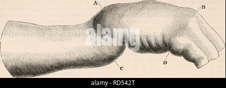 . Die cyclopaedia von Anatomie und Physiologie. Anatomie, Physiologie, Zoologie. 1522 HANDGELENK - GEMEINSAME (abnormalen Anatomie). der dorsalen Vorsprung an der Wurzel in Zoll über die der anderen Hand. Diese dex Finger (von A nach Bfig. 93-k), auf der über die Länge wurde offensichtlich durch jurcd Seite verursacht, gab ein Überschuss an Länge von einer halben die Präsenz der abgetrennte Epiphyse, die Bild. 934.. Die Verknüpfung der Epiphyse des Radius, mit Verschiebung nach hinten von der Hand und Carpus, - Sammlung Autor. Hatte superadded auf den Gipfel des Carpus und wurde wieder vorgenommen, das Handgelenk. Stockfoto