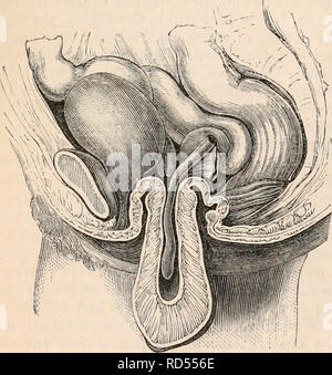 . Die cyclopaedia von Anatomie und Physiologie. Anatomie, Physiologie, Zoologie. Unvollständige Invertierung der Gebärmutter. (Nach J. G. Forbes.) Der Fundus ist Anfang durch os uteri herausragt, ziehen, nachdem es die Eileiter, der in die hohle Mit den umgekehrten Organ gebildet werden. dilatation der Gebärmutterhöhle durch einen Tumor von der Größe einer abgeflachten Aprikose, die ex war - in dem Moment, wenn die Gebärmutter pelled kam Abb. 471.. Komplette Inversion der Gebärmutter. (Diagramm), in der er vollständig umgekippt, - die Gewalttätigen ac-tion der Bauchmuskulatur und Membran vermutlich hier produzieren oder Beihilfe Stockfoto