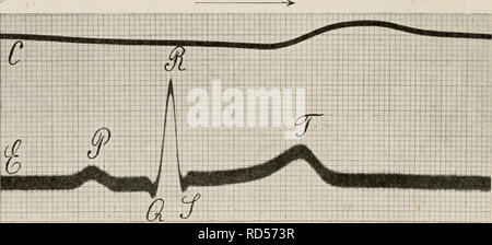 . Elektrobiologie, die Lehre von den elektrischen Vorgängen im Organismus in moderner Grundlage dargestellt. Elektrophysiologie. - 84 - kardiogramm zu entziffern (Nicolai). Weitere genauere Unter-suchungen eine blossgelegten Herzen von: und Ableitung einzelner Faserbündel werdener vielleicht bessere Aufklärung in of this Richtung schaffen. Inzwischen hat der Mensch rein empirisch Sterben ver-schiedenen Formen des Elektrokardiogramms unter physiologischen und pathologischen Bedingungen aufgenommen und so eine elektrodiagnostische Methode zui-henkes lolland der Herz-diesem gewonnen. Abweichungen vom Stockfoto