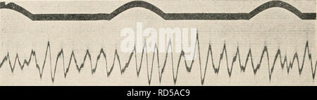 . Elektrophysiologie menschlicher Muskeln. Elektrophysiologie. 82 Versuche über sterben Willkürkontraktion. Das Maß des jeweiligen Druckes kann eine dem Instrument ab-gelesen und 5/6 der Ausübung des Druckes dauernd kon-trolliert werden. Es zeigte sich, dass 5/6 der Ausübung einer solchen Willkürkontraktion der Fingerbeuger sterben Link des Galvanometer in frequenten Schwingungen oszillierte, daß auch abgeleitete der. Abi). 26. Bei WilUiürlvoiitraktion Unterarniflexoreu aktionsströme der 50er Rhytlimus der Hauptwellen, diesen Xebenzacken superponiert sterben. Zeitsohreibung' =, Sekimdennhr. Proje Stockfoto