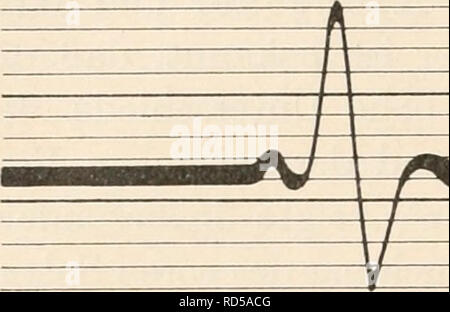 . Elektrophysiologie menschlicher Muskeln. Elektrophysiologie. 44 Über die Fortpflanzungsgeschwindigkeit der Kontraktionswelle.. Abb. 19. Aktionsstrom vom weißen Muse. Gastrocnemius des Kaninchens bei Reizung des motorischen Nerven mit einem einzelnen Induktionsschlag und Ableitung vom Muskels mit Elektroden - Distanz von 15 mm. (/ Kohlrausch.) Stimmgabel: 250 Schwingungen pro Sekunde. Bitte beachten Sie, dass diese Bilder aus gescannten Seite Bilder, die digital für die Lesbarkeit verbessert haben mögen - Färbung und Aussehen dieser Abbildungen können nicht Perfekt ähneln den extrahiert werden Stockfoto