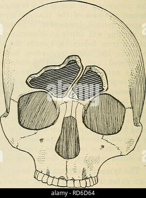 . Cunninghams Lehrbuch der Anatomie. Anatomie. Abb. 1075.-frontalen Nebenhöhlen der durchschnittlichen Abmessungen, mit einem Medial Septum (Logan Turner). Abb. 1076. - Ein großes Recht Frontalis mit Septum schräg nach links (Logan Turner). Form das Mastoid Zellen, die aus dem antrum ausstrahlen, und entweder direkt oder indirekt mit ihm kommunizieren durch kleine Öffnungen. In den pneumatischen Art der mastoid Der gesamte Prozess wird durch diese Zellen, die nach oben in den squamous Teil erweitern ausgegraben, leitet mit der posterioren Wand des knöchernen Meatus (border-Zellen) und rückwärts in den Hinterhauptbein. Eiter ret Stockfoto