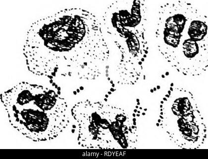 . Ein Handbuch der giftigen Pflanzen, vor allem des östlichen Nordamerika, mit kurzen Anmerkungen zu Wirtschafts- und Heilpflanzen, und zahlreichen Abbildungen. Giftige Pflanzen. SCHIZOPHYTA - SCHIZOMYCETES 171 giftige Eigenschaften. Nicht vollständig untersucht, aber wahrscheinlich die gleichen wie die der nächsten Organismus. Streptococcus pyogenes. Immunität. Nicht bekannt. Streptococcus pyogenes, Rosenbach. (Streptokokken erysipelatos, fehleisen) Krankheit produziert. Dieser Organismus in verschiedenen Formen von Entzündungen und septischen Entzündung im Allgemeinen, manchmal allein, manchmal verbunden mit Micrococcus pyogenes Albus, und Aureus. Seine speci Stockfoto