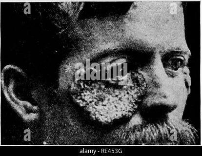 . Ein text-Buch auf die pathogenen Bakterien und Protozoen für Studenten der Medizin und Ärzte. Bakteriologie; pathogenen Bakterien und Protozoen. 748 Blastomykose aus einer Verallgemeinerung der blastomycetic Infektion, die nicht häufig geschieht. Nach der Arbeit von Gilchrist hat deutlich gemacht, der symptomatologie und Parasitologie der Krankheit, eine Anzahl an anderen Fällen berichtet wurden, und Ricketts * eine exzellente und ausführliche Zusammenfassung aller Fälle mit Referenzen auf die Literatur bis zu diesem Datum veröffentlicht. Eine andere sehr interessante Papier von Montgomery,! Im Jahr 1902 veröffentlicht wurde, enthält einen herrlichen Stockfoto