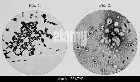 . Der bakteriologie in der Medizin und Chirurgie. Ein praktisches Handbuch für Ärzte, Gesundheit Offiziere und Studenten. Die Bakteriologie. Allgemeine GHABACTEBISTIGS von BAGTEBIA. 37 geformte Formen, wie es häufig in der diplococcus der Pneumonie gesehen oder, im Gegenteil, wie in der diplococcus von gonorrhea, wo der Kokken scheinen gegen einander abgeflacht werden. Die Zellen, die sich in einer Kluft. Single coccus, unregelmäßig gruppiert. Diplococcus der Pneumonie, mit Sur-Staphylococcus. Rundung Kapsel. Abb. 3. Abb. 4.. Bitte beachten Sie, dass diese Bilder aus gescannten Seite Bilder, die digital enhanc wurden extrahiert werden Stockfoto