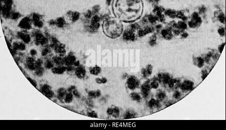 . Handbuch der Bakteriologie. Die Bakteriologie. Abb. 62. - Blastomyces dermatitidis (Gilchrist): Sek - tion tlirough einen Abszess Hohlraum sliowin^ den Organismus mit doppelt konturierte Membran X looo. [Durch die Art pro-Mission von Dr. T. Caspar Gilchrist.] Buddins. Abb. 63. - Blastomyces dermatitidis (Gilchrist) : Zeigen ing die aufkeimende Form des Organismus "in der Eiter eines Abszesses Buchse X looo. [Mit freundlicher Genehmigung von Dr. T. Caspar Gilchrist.] Formen (Abb. 63), die denen von normalen Hefezellen, werden oft mit Met, und es scheint, als ob angehende die übliche Methode der Fortpflanzung; einige ce Stockfoto