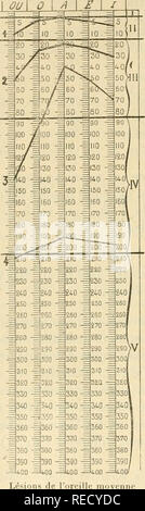 . Comptes Rendus hebdomadaires des séancen de l'Académie des sciences. Wissenschaft - Gesellschaften, etc.; Wissenschaft; Wissenschaft. Go/j ACADÉMIE DKS WISSENSCHAFTEN. serons en présence d'une otite scléreuse mixte, a%' eg lésions de l'oreille Moyenne et de l'oreille Internierten, Lorsque nous rencontrerons des trous dans Abb. I.. OO ^00^=1400 • 5 ns de l'oreille Moyenne (olorrhées). Abb. 2.. Bitte beachten Sie, dass diese Bilder sind von der gescannten Seite Bilder, die digital für die Lesbarkeit verbessert haben mögen - Färbung und Aussehen dieser Abbildungen können nicht perfekt dem Original ähneln. extrahiert. Académie des Stockfoto