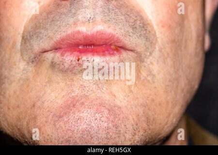 Herpes auf den Lippen des Menschen. Herpes. Lippe Behandlung, kopieren Raum Stockfoto