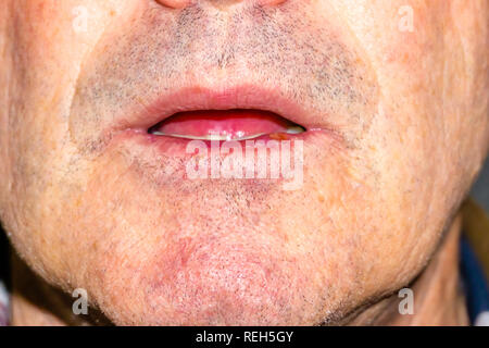 Herpes auf den Lippen des Menschen. Herpes. Lippe Behandlung, kopieren Raum Stockfoto