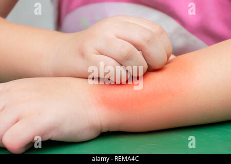 Allergien gegen Mückenstiche. Kinder sind Kratzer auf ihre Arme. Nachdem die Mückenstiche. Kratzer bis Rötung. Stockfoto