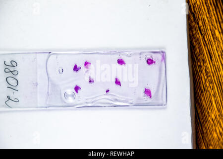 Schichten des Tumors unter Glas. Die histologische Untersuchung der tumorzellen Für die Anwesenheit von Krebs Stockfoto