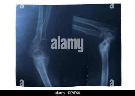 X-ray von unterarm auf weißem Hintergrund Stockfoto