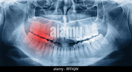 X-ray-Scan des Menschen Zähne, simulierte Schmerzen Stockfoto