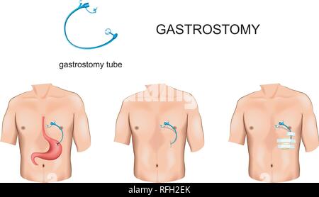 Vector Illustration von gastrostomie Rohr mit speiseröhre Verstopfung Stock Vektor