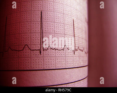 Sinus Herzrhythmus auf EKG-Aufzeichnung Papier zeigt normale P-Welle, PR- und QT-Intervall und QRS-Komplexe, EKG-Papier Stockfoto