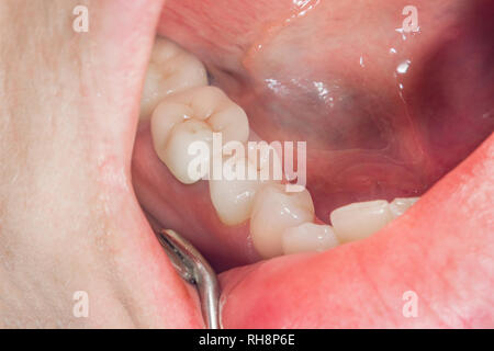Zahnmedizinische Wiederherstellung der verfaulten Wurzeln der Zähne mit Keramik Kronen. cast Beiträge Zahnheilkunde Stockfoto