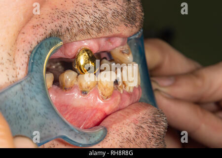 Schlechte Zähne des Patienten beim Zahnarzt Zahnarzt Nahaufnahme Makro. Karies, Zahnbelag schadet Rauchen Stockfoto
