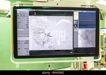 Digitale Subtraktionsangiographie, DSA-lab, Monitor große C-Arm angiograph, Operationssaal mit X-ray Medizintechnik im Krankenhaus. Stockfoto