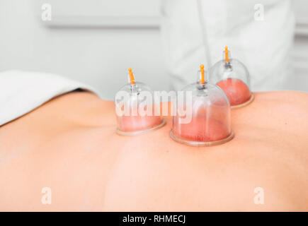 Chinesische Resort und Behandlung. Akupunktur cups auf weibliche zurück. Akupunktur Massage close-up Stockfoto