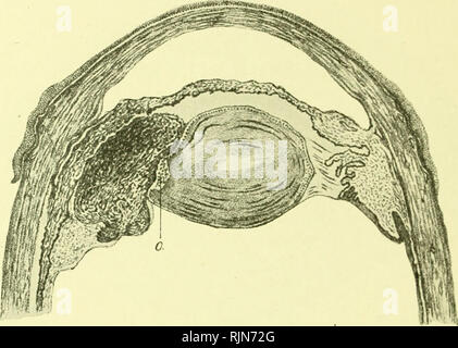 . Pathologie und Bakteriologie [elektronische Ressource]. Augenheilkunde; Auge; Auge; Bakteriologie; Augenheilkunde; Auge; Bakteriologie; Auge. 6 o2 DEGENERATIONEN Toxin die Zelle der vorderen Linsenkapsel mit - beeinflussen könnten, spannende Änderungen in den tiefen Schichten der Hornhaut oder des Endothels der Descemet Membran. Eine andere Theorie Attribute die Veränderungen der Linse bei der Anterioren Pol mit der Rückseite der Hornhaut zu kontaktieren. In einem Kleinkind Auge der Vorderkammer ist sehr flach, so dass sehr wenig Schwellung der Hornhaut genügt es bringen und. Abb. 270.-Abschnitt durch die vordere Hälfte der Stockfoto