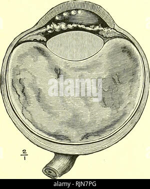 . Pathologie und Bakteriologie [elektronische Ressource]. Augenheilkunde; Auge; Auge; Bakteriologie; Augenheilkunde; Auge; Bakteriologie; Auge. Tuberkulösen IRITIS 537 Fett "Vielfalt der ''Keratitis punctata" (Abb. 245). Micro-scopical Prüfung dieser Ablagerungen zeigen Sie bestehen aus Sammlungen von mononukleären Leukozyten an der inneren Oberfläche des Endothels der Descemet Membran (siehe Seite 463). Verbreitet miliare tuberkulösen Knötchen kann mit in der iris ohne deutliche Anzeichen von iritis und mit der Bildung von nur wenige, wenn überhaupt, posterior synechias erfüllt werden. Microscop -. Abb. 245.- Die lateralen Hälfte Stockfoto