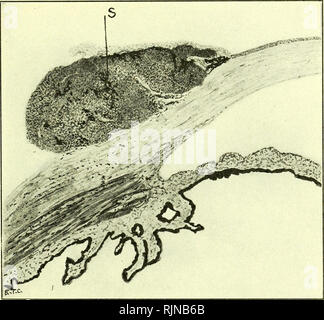 . Pathologie und Bakteriologie [elektronische Ressource]. Augenheilkunde; Auge; Auge; Bakteriologie; Augenheilkunde; Auge; Bakteriologie; Auge. EPIBULBAR SARKOM 199 eine solche Sicht. Es ist schwer zu sehen, wie Sie Ihren Weg durch die Kapsel in der Umgebung des Wachstums machen könnte. Hämatogene Pigmentierung, folgende Blutung in eine sarcomatous Wachstum, kann von melanotic Pigmentierung durch die hellere Farbe differenziert werden, die Goldenen oder braun, nicht schwarz, und indem Sie ein Bügeleisen Reaktion. Epibulbar Epibulbar Sarkom Sarkom - beginnt in der Regel in die Bindehaut am Rand der Hornhaut (Abb. 103). T Stockfoto