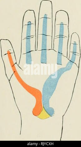 . Atlas der Angewandten (Topografische) menschlichen Anatomie für Studenten und Praktiker. Anatomie. Flexor Muskeln (Hülse) mit dem kleinen Finger Ulnaris Proximal Ende der Gemeinsamen Synovial Mantel Abb. 98.. Bitte beachten Sie, dass diese Bilder sind von der gescannten Seite Bilder, die digital für die Lesbarkeit verbessert haben mögen - Färbung und Aussehen dieser Abbildungen können nicht perfekt dem Original ähneln. extrahiert. Bardeleben, Karl Heinrich, 1849-1919; Haeckel, Ernst Heinrich Philipp August, 1834-1919. London: Rebman Limited, New York, Rebman Unternehmen Stockfoto