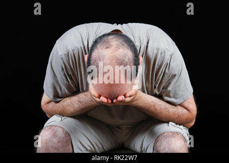 Mann traurig über Haarausfall Problem Stockfoto