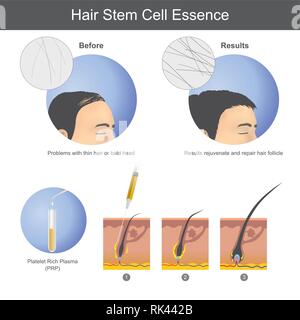 Stimuliert das Haarwachstum mit Platelet rich Plasma (PRP) auf die Kopfhaut zu injizieren, bis es zur Haarwurzel durchdringt. Infografik health care. Stock Vektor