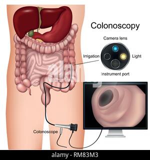 Colonoscopy Verfahren mit der Bezeichnung 3D-Vektor Grafik auf weißem Hintergrund Stock Vektor