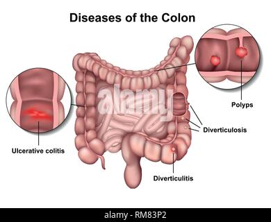 Erkrankungen des Dickdarms 3 d medical Vector Illustration auf weißem Hintergrund Stock Vektor