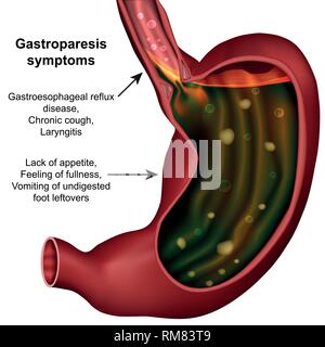 Gastroparese Magen medizinische Vector Illustration auf weißem Hintergrund Stock Vektor