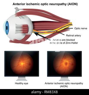 Ishemic Optikusneuropathie medizinischer 3d Vector Illustration auf weißem Hintergrund Stock Vektor