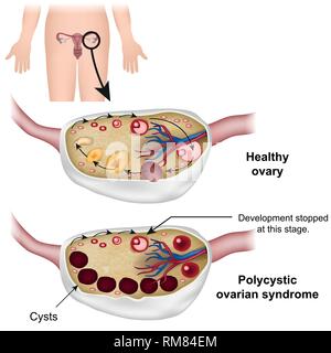 Polyzystischem Ovarialsyndrom medizinische Vector Illustration Stock Vektor