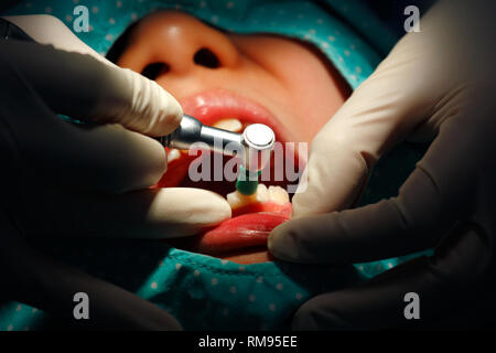 Closeup zahnmedizinische Zähne polieren, um die Reinigung des Patienten Zähne Stockfoto