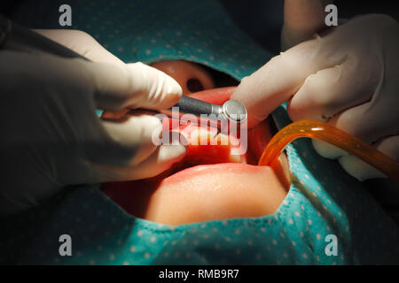 Closeup zahnmedizinische tiefe Reinigung durch Skalierung Plakette von Patienten Zähne Stockfoto