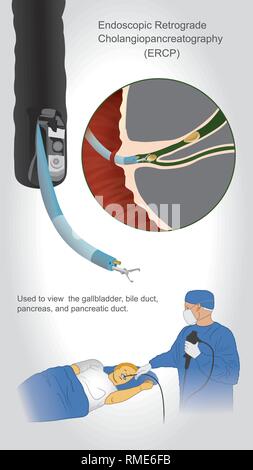 Endoskopische retrograde cholangiopancreatography (ERCP) ist eine Untersuchung, die zum Anzeigen und ggf. Biopsie die Gallenblase, Gallenwege, Bauchspeicheldrüse, ein Stock Vektor