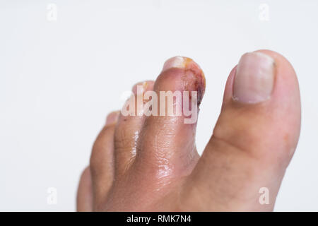 Mit dem Finger auf dem Bein. Eitrige Finger. Wunde schließen oben. eitrige Wunde Stockfoto