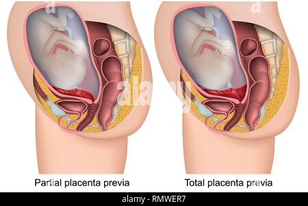 Plazenta brevia Schwangerschaft 3d Vektor Illustration auf weißem Hintergrund Stock Vektor