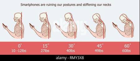 Die schlechte smartphone Körperhaltungen, der Winkel der Biegekopf, um den Druck auf die Wirbelsäule, Vektor flachbild Cartoon Illustration. Mann mit Handy mit Hals Stock Vektor