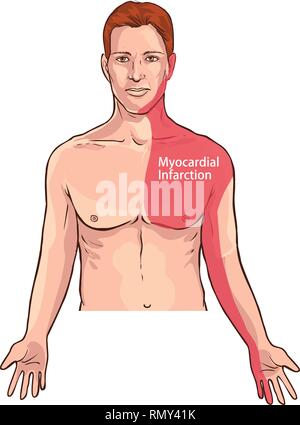 Vector Illustration eines Herzinfarkt schmerzen Lage (Myokardinfarkt) Stock Vektor