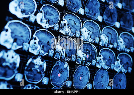 MRI Magnetic Resonance Image Scan eines Patienten mit einem Tumor im Hirnstamm. Stockfoto