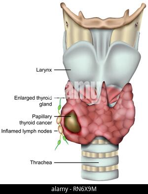 Schilddrüsenkrebs 3 d medical Vector Illustration auf weißem Hintergrund Stock Vektor