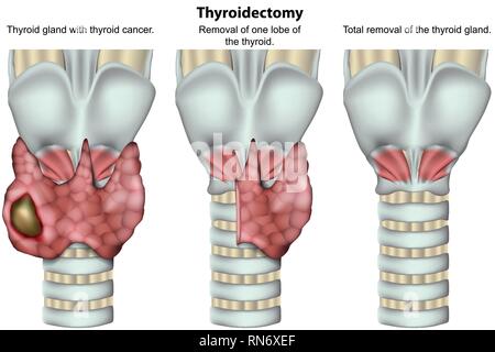 Thyreoidektomie Schilddrüse 3d medical Vector Illustration auf weißem Hintergrund Stock Vektor