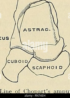 . Anatomie, beschreibende und angewendet werden. Anatomie. 256 SPEZIELLE ANATOMIE DES SKELETTS der ersten Phalanx der großen Zehe. Gleich unter die Basis dieser Phalanx, die internen sesamoid Bone ist zu spüren. Schließlich ist die erweiterte Enden der Knochen bilden die letzte gemeinsame der großen Zehe zu spüren. Auf der Außenseite des Fußes die hinteren knöchernen Punkt ist die externe Tuberkel des calcaneus, mit der Kante Trennen der hinteren von der äußeren Oberfläche der Knochen. Vor diesem der größere Teil der externen Siu^Gesicht der Calcaneus ist subcu - Taneous; auf ihm, unter und in her Stockfoto