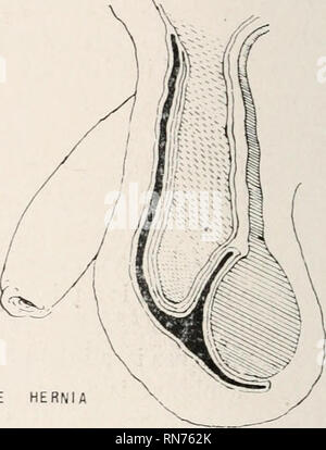 . Anatomie auf den Punkt: Eine Abhandlung über die Anatomie des Menschen in seiner Beziehung zu Osteopathie. Die menschliche Anatomie; osteopathische Medizin osteopathische Medizin; Anatomie. INFANTILE HERNIE. Bitte beachten Sie, dass diese Bilder sind von der gescannten Seite Bilder, die digital für die Lesbarkeit verbessert haben mögen - Färbung und Aussehen dieser Abbildungen können nicht perfekt dem Original ähneln. extrahiert. Laughlin, William Ross. Kirksville, Missouri: William Ross Laughlin Stockfoto