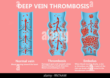 Thrombose. Von den normalen Blutfluss zu Blutgerinnsel Stockfoto